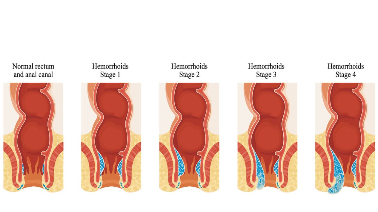 hemoroid türleri